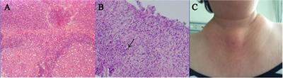 Clinical, Pathological, Laboratory Characteristics, and Treatment Regimens of Kimura Disease and Their Relationships With Tumor Size and Recurrence